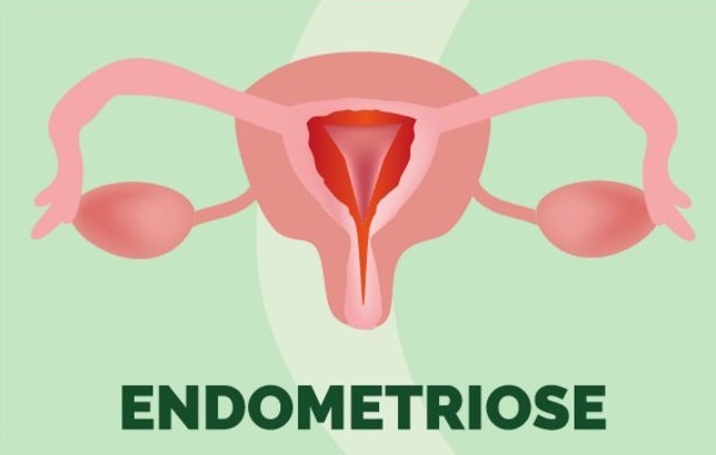 endometriose.jpg