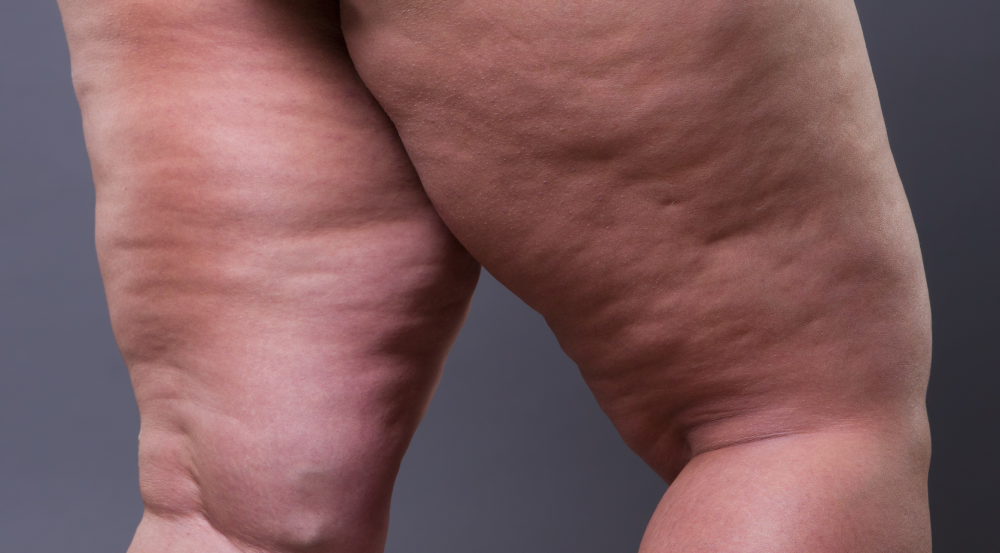 Excesso de gordura localizada pode ser sinal de problema vascular